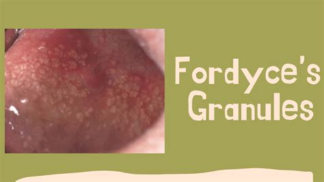 grain de fordyce|Fordyce spots